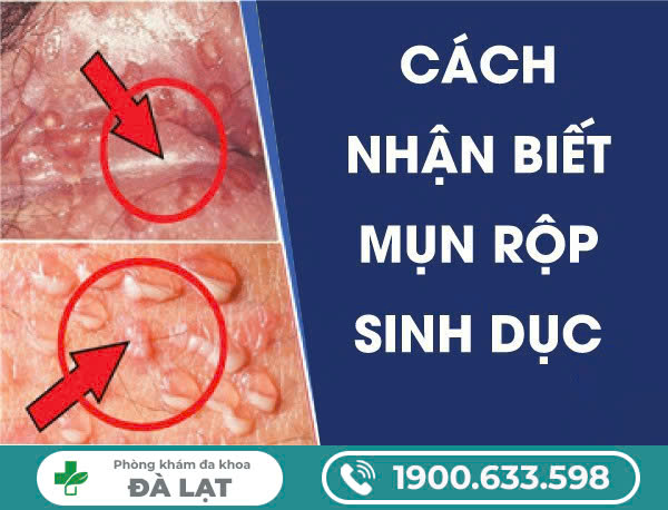 DẤU HIỆU NHẬN BIẾT MỤN RỘP SINH DỤC VÀ CÁCH CHỮA